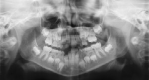 Dental Radiographs (X-Rays) - Pediatric dentist Dr. Tricia Ray serving Salem, Keizer, Dallas and Silverton, OR